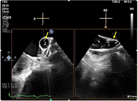 Diagnosis of Persistent Left Superior Vena Cava by Transesophageal Echocardiography During ...