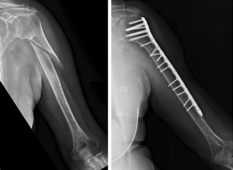 Left Humerus Fracture