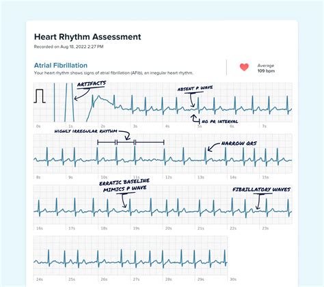 What P Waves Look Like on Your Watch ECG | Qaly