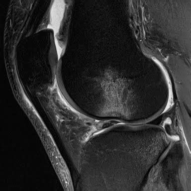 Image result for Sulcus Sign Lateral View