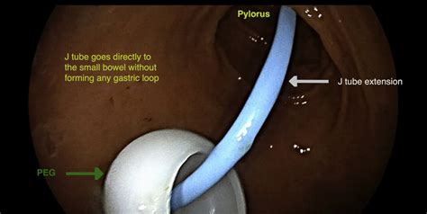 PEG J tube placement with optimization of J tube insertion - VideoGIE