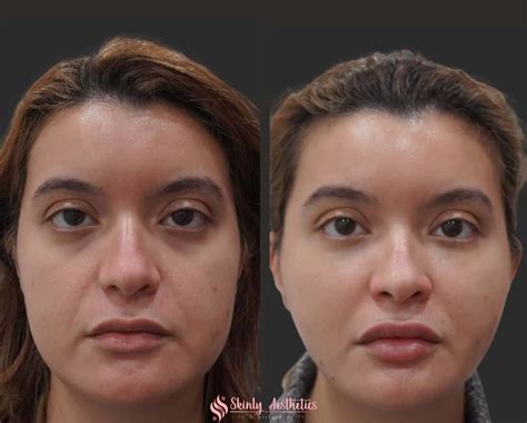 Cheek Fillers - Before & After Results at Skinly