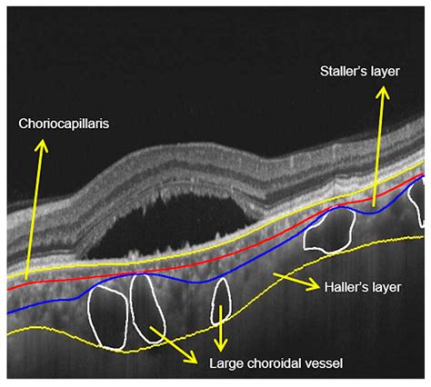 Choroid Layers