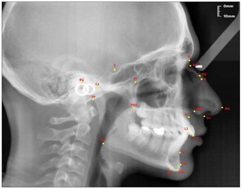 Nasal Bone Anatomy X Ray