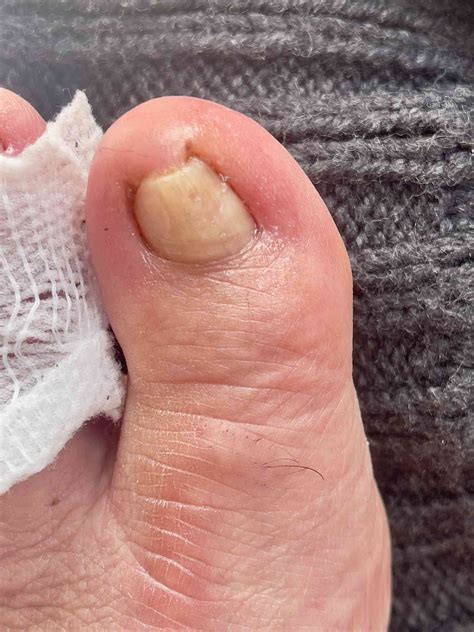 Curled Toenails Fix 的图像结果