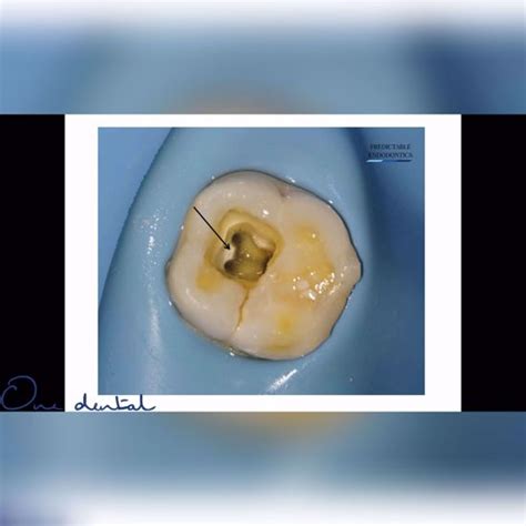 Access cavity preparation and canal location-One Dental is the Biggest ...