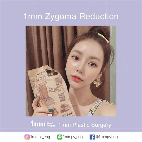 Zygoma Reduction, with a simple touch by 1mm plastic surgery, you will now get smaller and ...