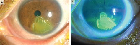Rare case of autoimmune keratitis after Atezolizumab Treatment reported ...