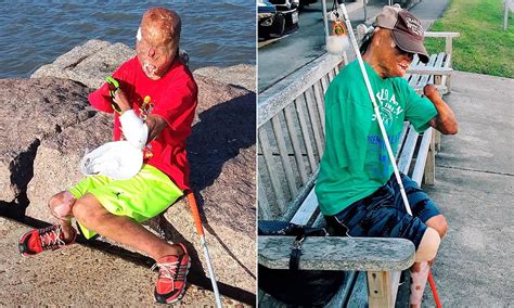 6th Degree Burn Survivor