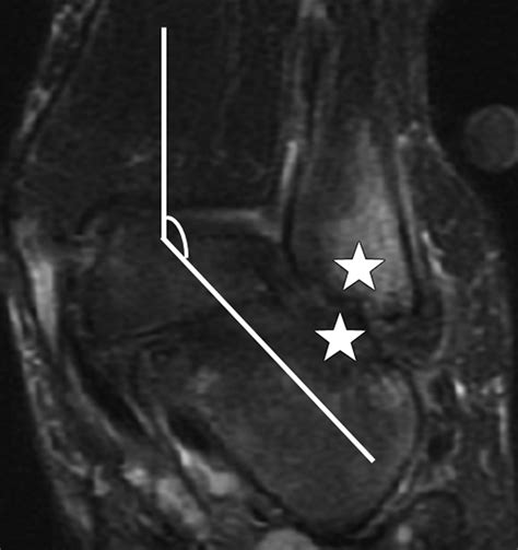 Bone Marrow Edema Patterns in the Ankle and Hindfoot: Distinguishing ...
