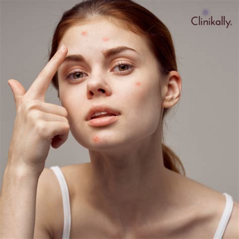 Is Acne Genetically Inherited?: Doctor's Guide | Clinikally