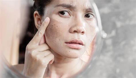 5 Amazing Benefits of Black Cumin Seed Oil for Skin - lifeberrys.com