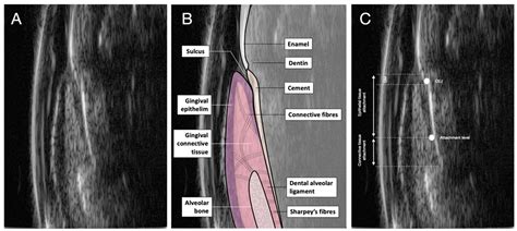 Intraoral Ultrasonography for the Exploration of Periodontal Tissues: A ...