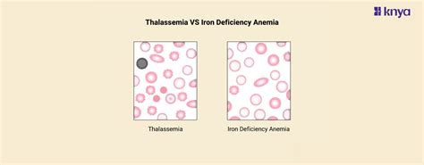 Thalassemia vs Iron Deficiency Anemia | Key Differences Explained! – Knya