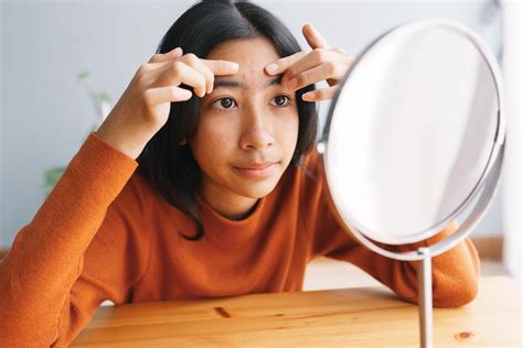 Traditional Chinese Medicine And Acne