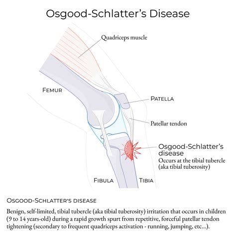 Clinical Pathology: Childhood-Onset Bone Diseases | ditki medical ...