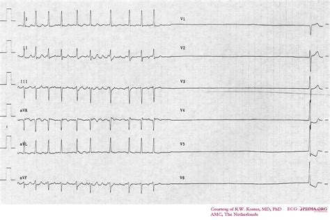 Sick sinus syndrome electrocardiogram - wikidoc
