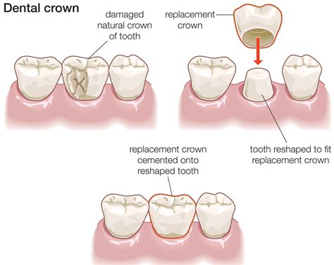 Dental Crowns in Sydney CBD | Sydney CBD Dentistry