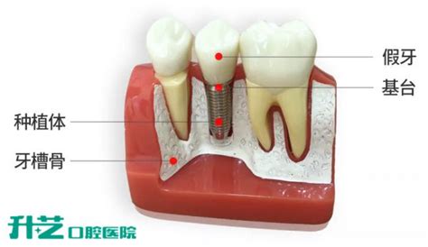 门牙缺失了，选择种植门牙修复有什么特点呢？ | 升艺口腔医院