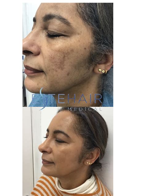 Exosome Hair Loss Treatment - Este Hair Medical