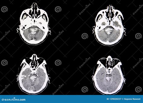 CT scan hemorrhagic stroke stock image. Image of intracerebral - 129020227 - hemorrhage in pons