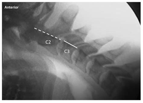 Diagnostic Accuracy of Videofluoroscopy for Symptomatic Cervical Spine ...