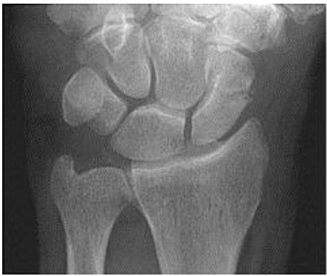 Scaphoid Fracture Test 的图像结果