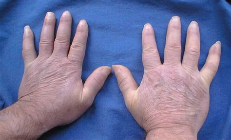 Image result for Diffuse Systemic Scleroderma