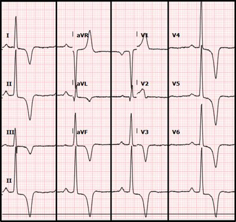 Dilated Cardiomyopathy Ecg