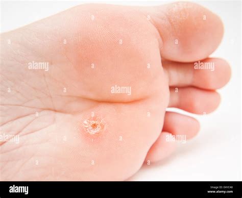 Pain Under Callus Ball Foot at Susanne Drennan blog