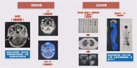 鼻咽癌临床试验,即将在美国上市的中国国产鼻咽癌免疫治疗(PD-1)新药派安普利单抗(Penpulimab、AK105)临床试验正在招募患者-无癌家园