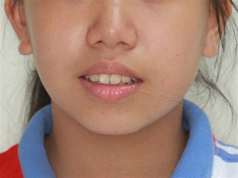 隐适美隐形矫正病例（高角，前突龅牙，拔牙矫正，下巴改形） - 知乎