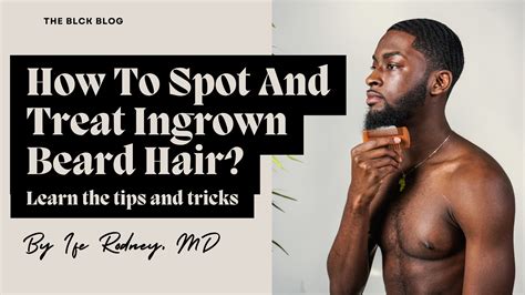 How To Spot And Treat Ingrown Beard Hair – BLCK Hair Care