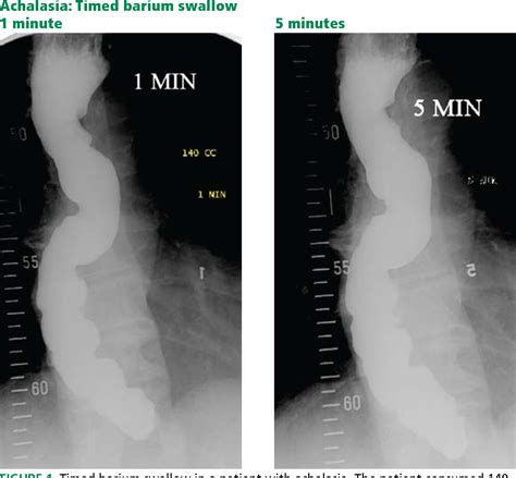 Marshmallow Bagel Barium Swallow at June Blackwell blog