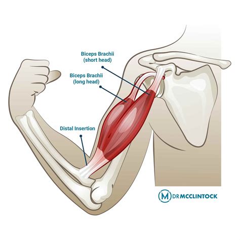 Understanding Bicep Tendonitis - Kyle McClintock, DO | Orthopedic Surgeon Roseville, CA