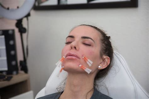 Threading Facelift Before and After 的图像结果