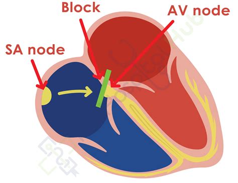 Heart Blocks
