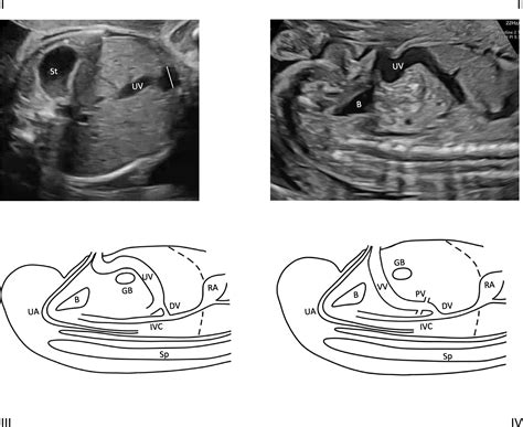 Isolated fetal umbilical vein varix and the association with intrauterine fetal death and fetal ...