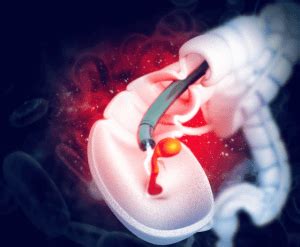 Image result for Polypectomy Recovery