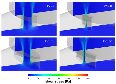 Computational Fluid Dynamics Simulations of Mitral Paravalvular Leaks ...
