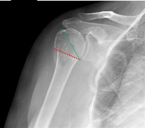 Humerus Fracture