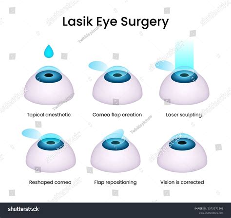Stages Lasik Eye Surgery Stock Vector (Royalty Free) 2575571361 | Shutterstock