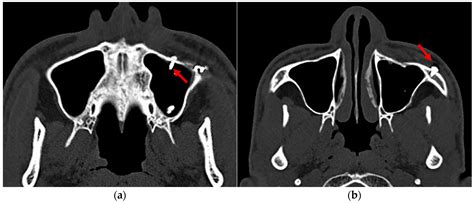 Maxillary Sinus Bone Fracture Facial Fractures (poster)