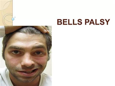 Bell's Palsy Facial Paralysis Guide | PPT