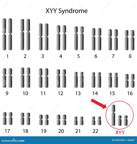 Xyy Syndrome Crime
