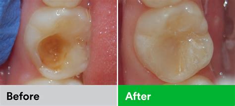 Posterior Restoration | Dental Products | 3M India