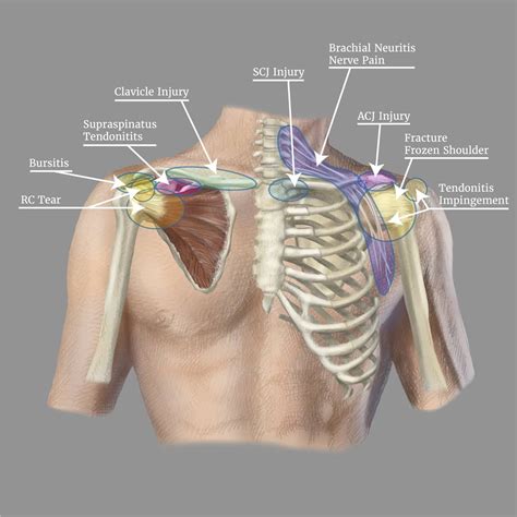 Shoulder Bursa Pain Location at Jacob Honda blog