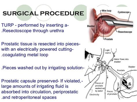 Image result for Turp Procedure Explained