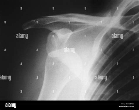 X-RAY - DISLOCATED SHOULDER Stock Photo - Alamy