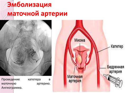 Дисфункциональные маточные кровотечения - online presentation